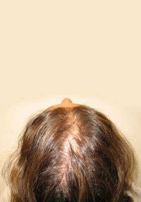 hair transplant photos