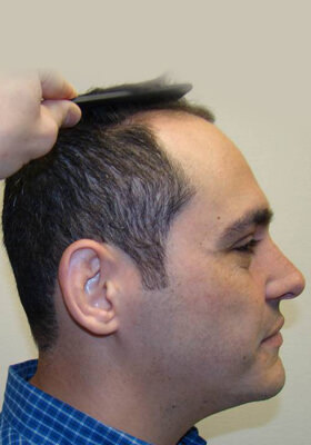 hair transplant before after Photos