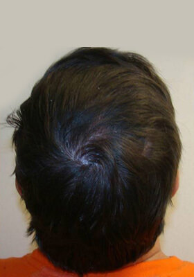 hair transplant photos