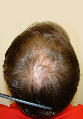 hair transplant photos