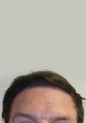 hair transplant photos