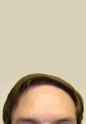 hair transplant photos