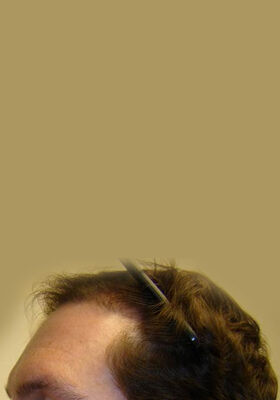 hair transplant photos