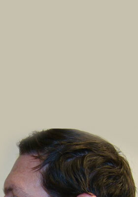 hair transplant photos