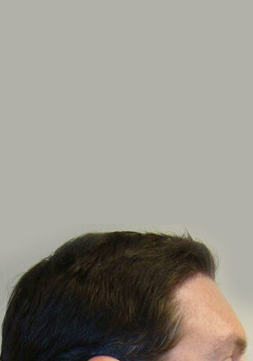 hair transplant photos