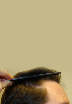 hair transplant photos