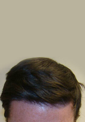 hair transplant photos