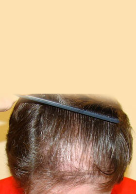hair transplant photos