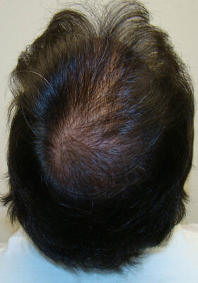 hair transplant photos