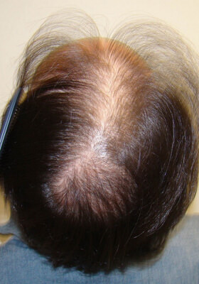 hair transplant photos