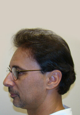 hair transplant photos