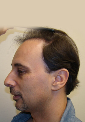 hair transplant photos