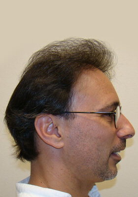 hair transplant photos