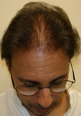 hair transplant before after Photos