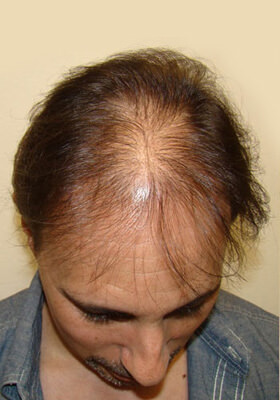 hair transplant before after Photos