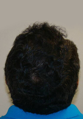 hair transplant photos