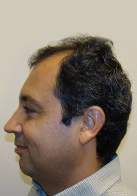 hair transplant photos