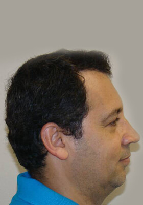 hair transplant photos