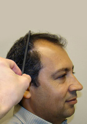 hair transplant photos