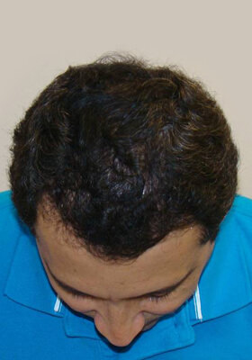 hair transplant before after Photos