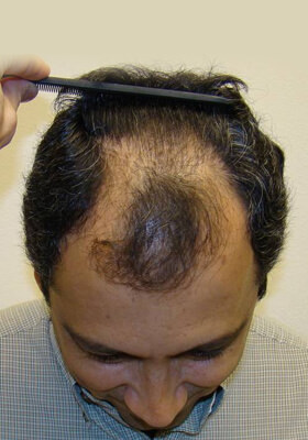 hair transplant photos