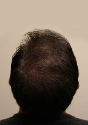 hair transplant photos