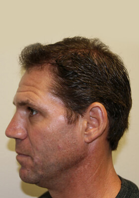 hair transplant photos