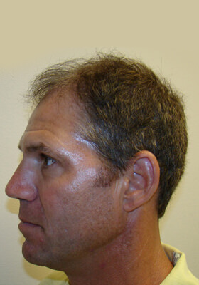 hair transplant photos