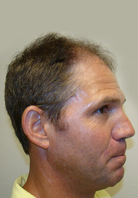 hair transplant photos