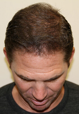 hair transplant photos