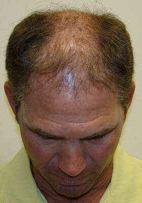 hair transplant before after Photos