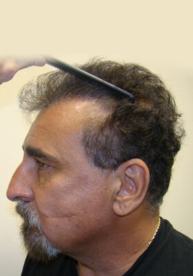 hair transplant photos