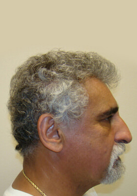 hair transplant photos