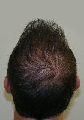 hair transplant photos