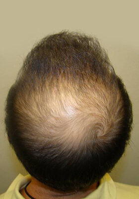 hair transplant photos