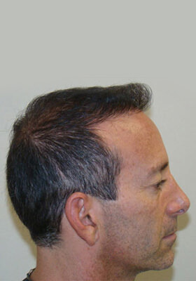 hair transplant photos