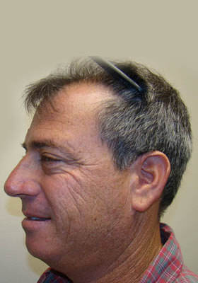 hair transplant photos