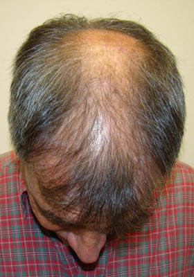 hair transplant photos