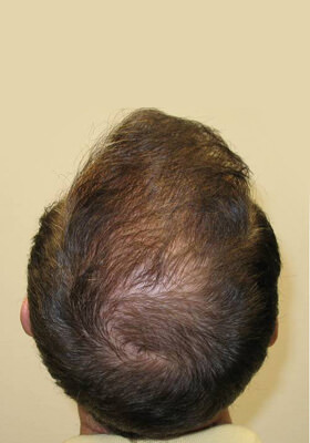 hair transplant photos