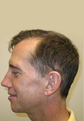 hair transplant photos