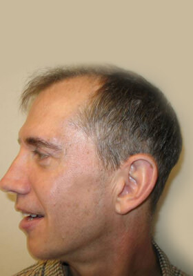 hair transplant photos