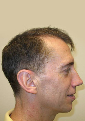 hair transplant photos