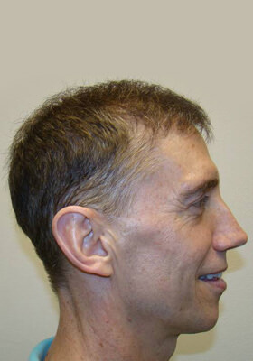 hair transplant photos