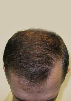 hair transplant photos