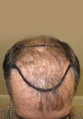 hair transplant before after Photos