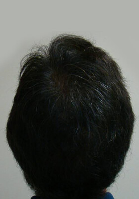 hair transplant photos