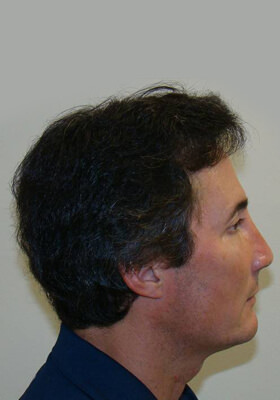 hair transplant photos