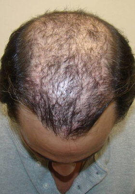 hair transplant photos