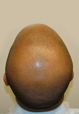 hair transplant photos