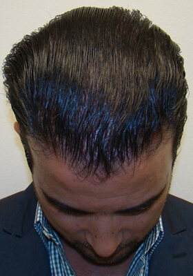 hair transplant photos